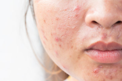 Que es el acné - Dermatologos Medellín